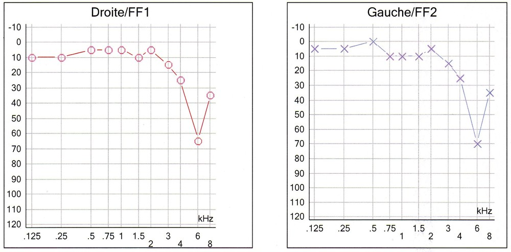 Audiogramme d'un traumatisme sonore aigu