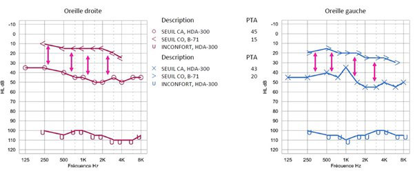 Audiogramme qui indique une surdité de transmission