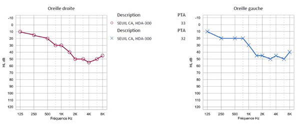 Audiogramme tonal par conduction aérienne 