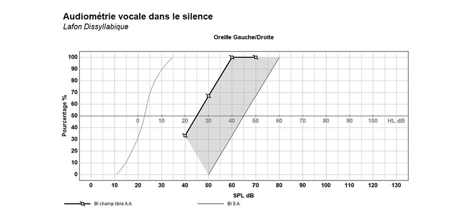 Exemple d'un audiogramme vocal d'un patient d'un centre auditif VivaSon
