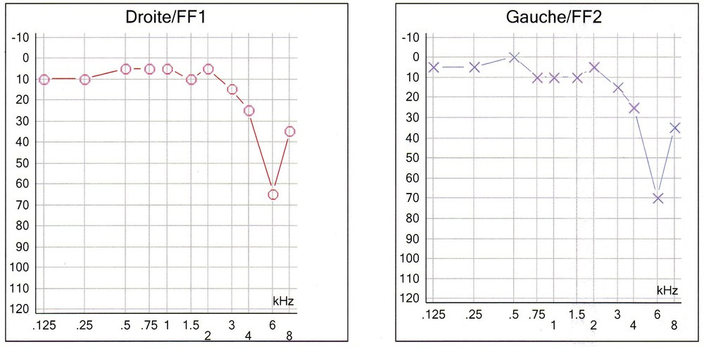 Audiogramme d'un traumatisme sonore aigu