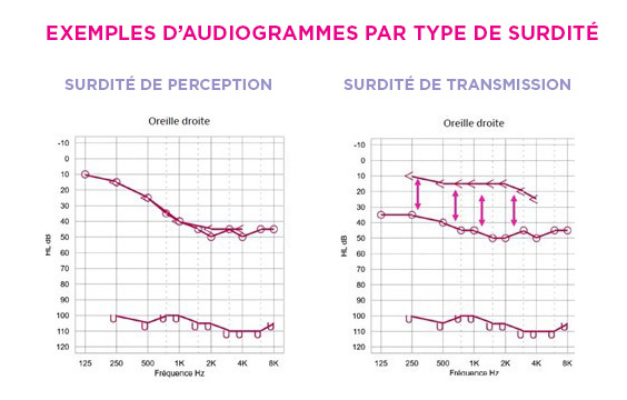 Exemples d'audiogrammes de surdité de perception et de transmission